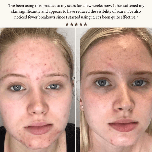 High Frequency Wand For Skin & Hair Loss