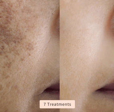 High Frequency Wand For Skin & Hair Loss