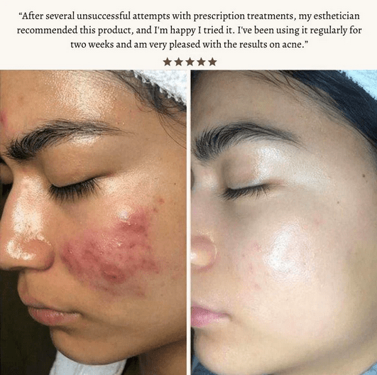 High Frequency Wand For Skin & Hair Loss