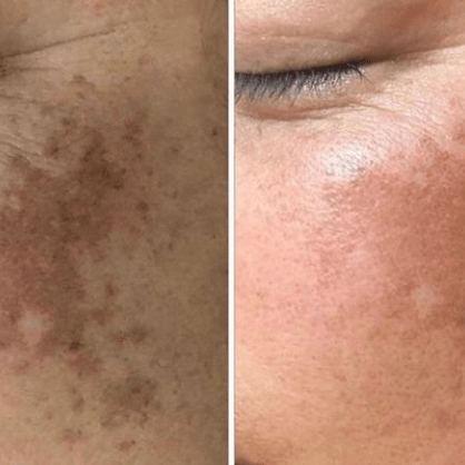 High Frequency Wand For Skin & Hair Loss