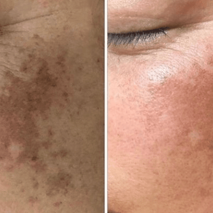 High Frequency Wand For Skin & Hair Loss