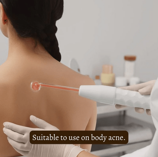 High Frequency Wand For Skin & Hair Loss