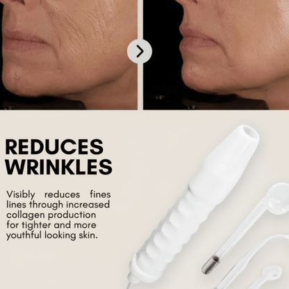 High Frequency Wand For Skin & Hair Loss