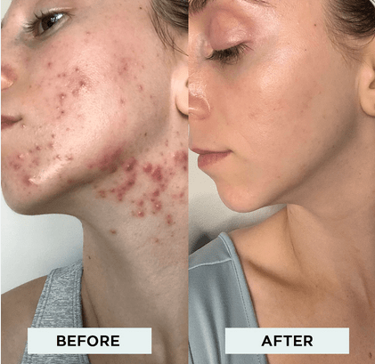 High Frequency Wand For Skin & Hair Loss