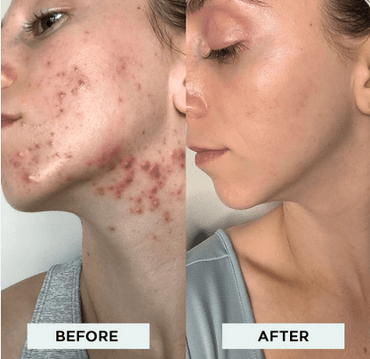 High Frequency Wand For Skin & Hair Loss