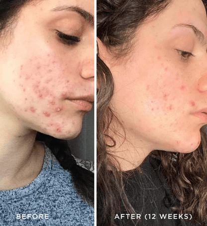 High Frequency Wand For Skin & Hair Loss