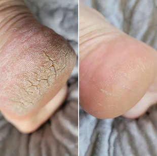 Electric Foot Grinder Exfoliater