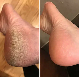 Electric Foot Grinder Exfoliater