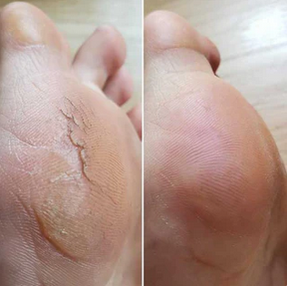 Electric Foot Grinder Exfoliater