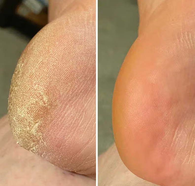 Electric Foot Grinder Exfoliater