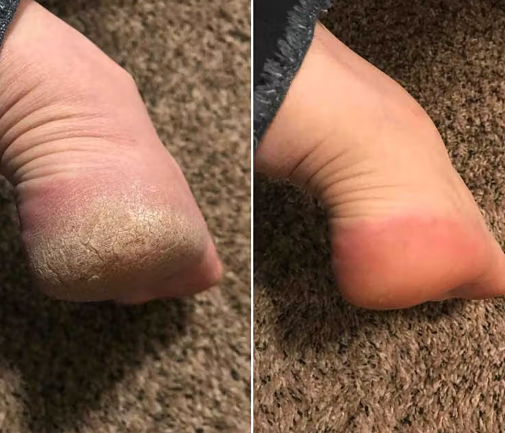 Electric Foot Grinder Exfoliater