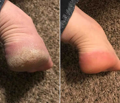 Electric Foot Grinder Exfoliater