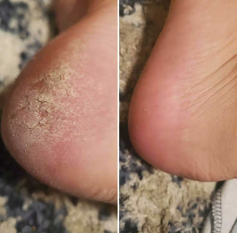 Electric Foot Grinder Exfoliater