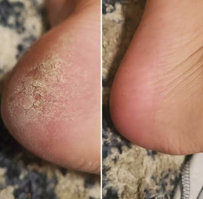 Electric Foot Grinder Exfoliater